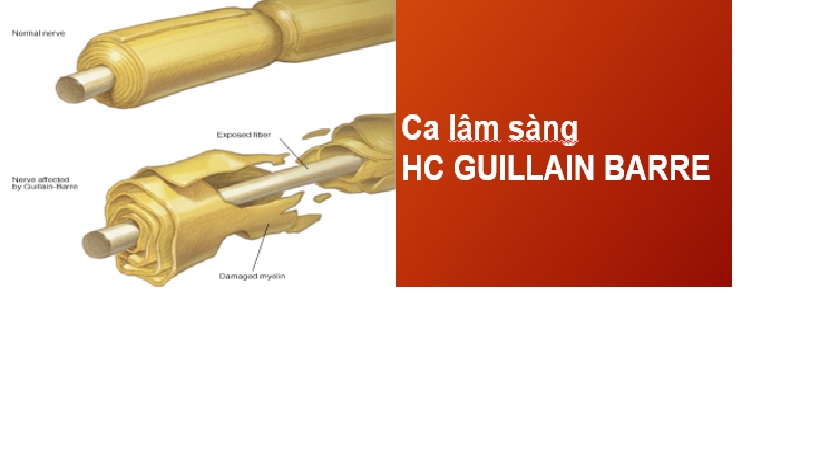  Hội chứng guillain barre slide : Tất cả những điều bạn cần biết