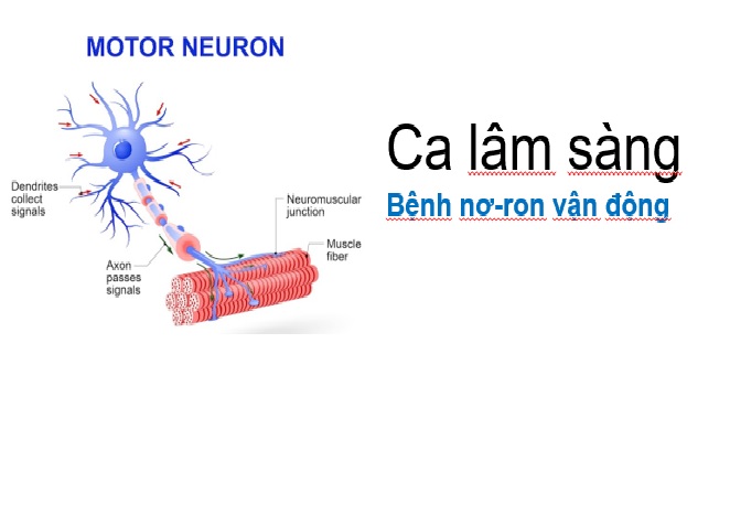 Có liệu pháp nào để điều trị bệnh ALS không?
